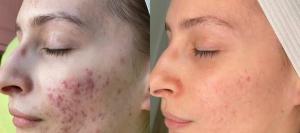 Enfrentando a acne de frente