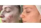 Enfrentando a acne de frente