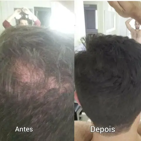 Micropigamentacao capliar
