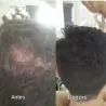 Micropigamentacao capliar