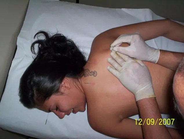 ACUPUNTURA CURA SÍNDROME DO PÂNICO