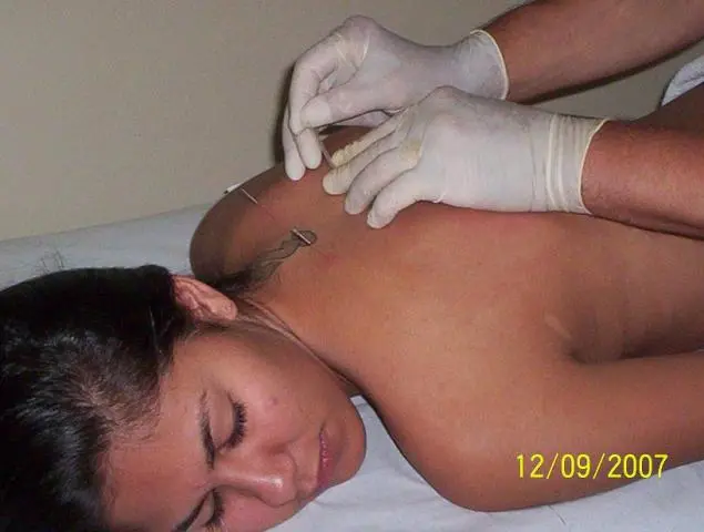 ACUPUNTURA CURA SÍNDROME DO PÂNICO